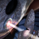 new optical implants